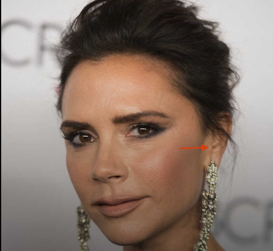 виктория бэкхем ухо козелок после пластики фейслифта