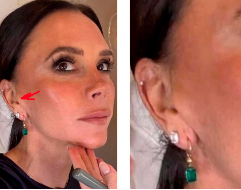 виктория бэкхем после фейслифта козелок звезды